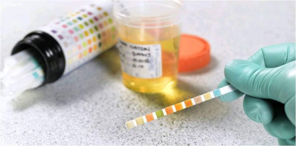 Un análisis de orina podría detectar el cáncer de páncreas temprano, sugiere un estudio