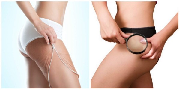 Elimina las estrías con azúcar