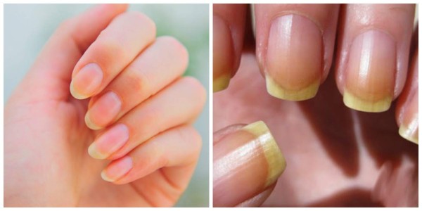 No más uñas amarillas