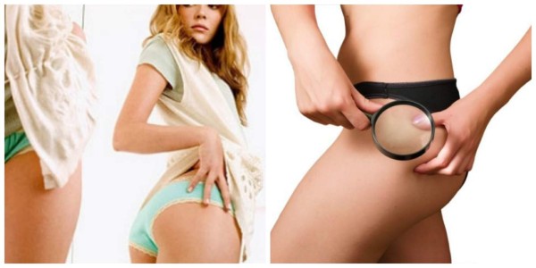 Como combatir la celulitis de forma natural