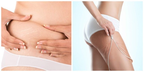 Alimentos para combatir las estrías