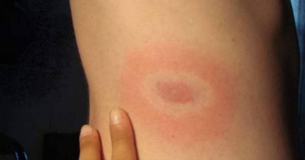 ¡Cuidado! Protéjase de la enfermedad de Lyme