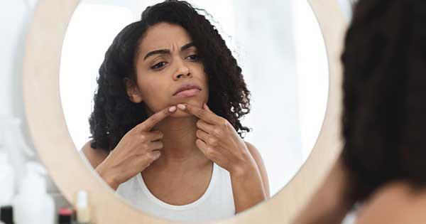 Las personas de piel morena son más susceptibles a manchas de acné