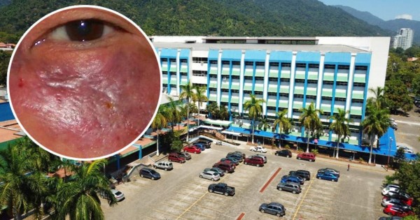 Detectan segundo caso de hongo negro secuela del covid en Honduras