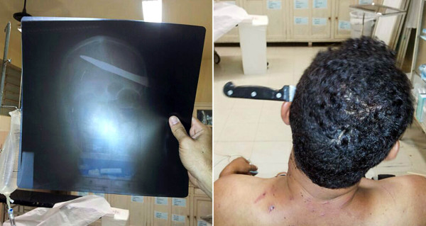 Llega a hospital con cuchillo en la cabeza