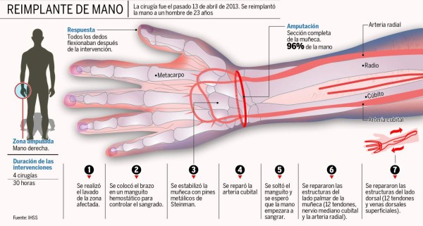 Hondureño recupera su mano gracias a un reimplante