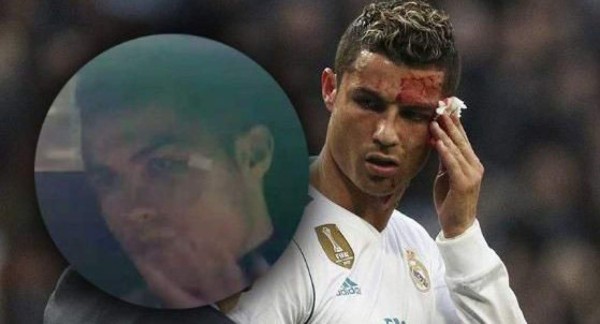 Cristiano Ronaldo reaparece con el ojo morado