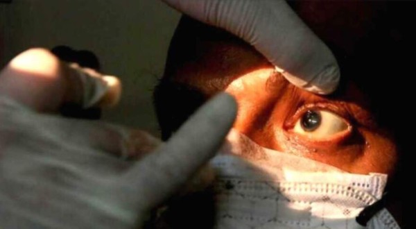 Covid-19: Honduras confirma 12 casos por hongo negro