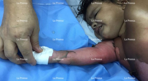 Niña de 2 años se quema el 80 % del cuerpo tras caerle chilate hirviendo  