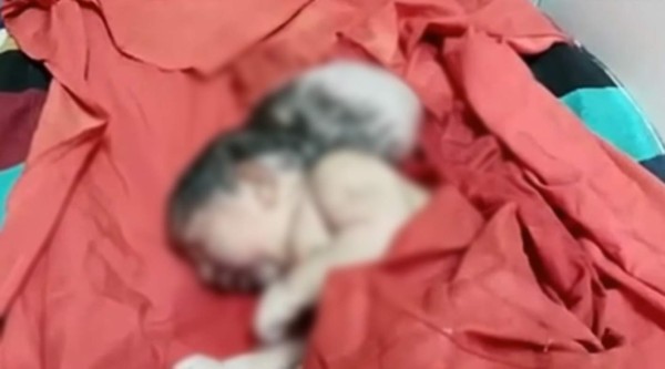 VIDEO: Nace bebé con tres cabezas en la India