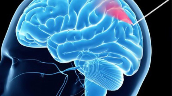 Crean una aguja de biopsia que hace más segura la cirugía cerebral