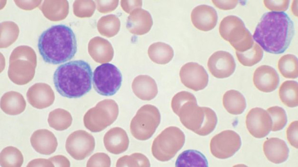 Las células madre del cordón umbilical pueden ayudar a pacientes con leucemia