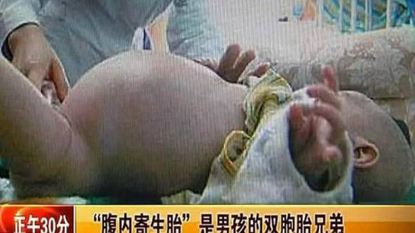 Hallan feto dentro de bebé de dos años
