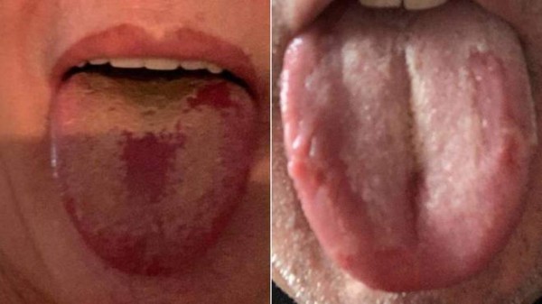 Lengua covid, el nuevo síntoma que podría estar asociado al coronavirus
