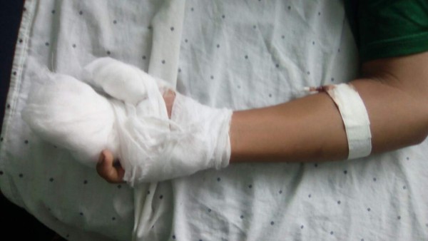 Llegan cinco quemados por pólvora al hospital Mario Rivas