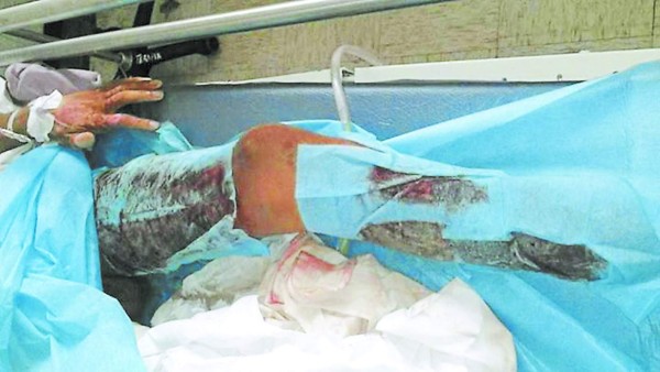 Hondureño quemado en la 'Bestia” clama ayuda en México