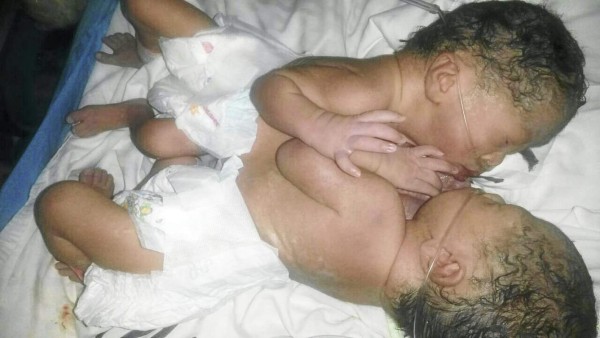 Siamesas sampedranas se mantienen estables