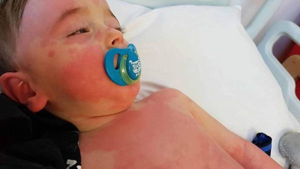 Qué es la enfermedad de Kawasaki, el síndrome que afecta a niños infectados por Covid 19