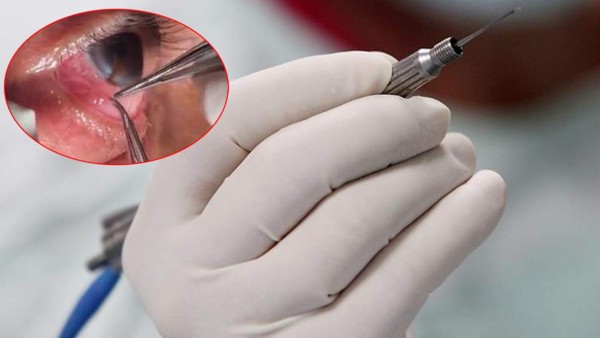 VIDEO: Extraen 20 gusanos vivos del ojo de un hombre