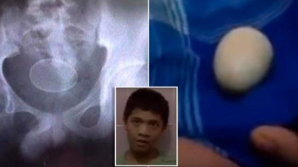 Akmal, el adolescente que 'pone' huevos