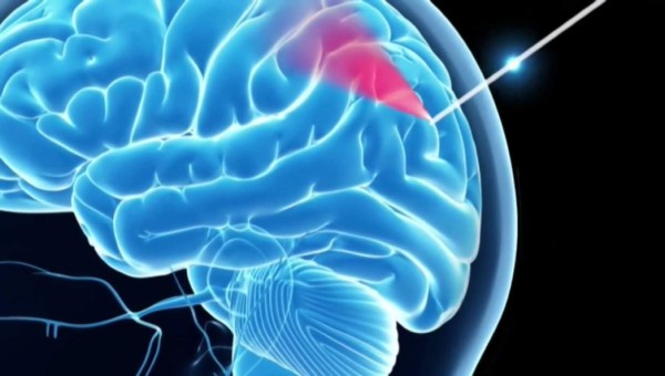 Desarrollan en Australia una 'aguja inteligente' para operaciones de cerebro