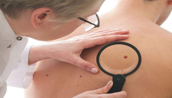 El melanoma no es el único cáncer de piel