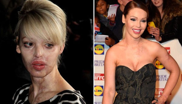 'Las cicatrices ya no me molestan': Katie Piper