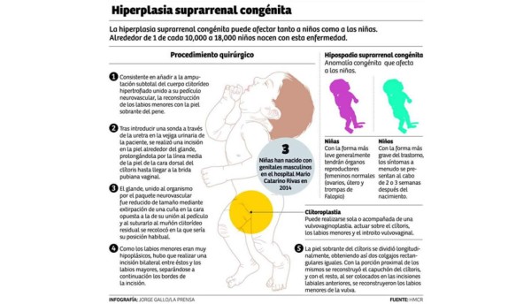 En el Mario Rivas operan a niñas que nacen con genitales ambiguos