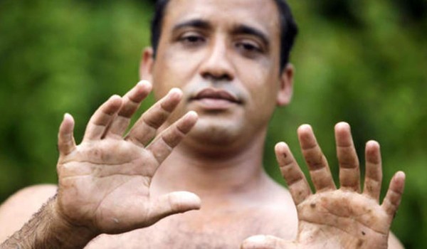 Un hombre muestra sus seis dedos.