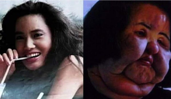 Mujer quedó desfigurada tras inyectarse aceite en el rostro