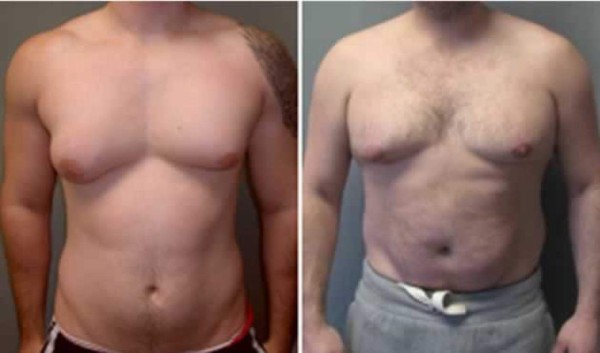 Video: A los hombres también les crece el busto