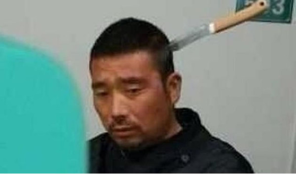 Chino espera paciente su turno en un hospital con un cuchillo en la cabeza