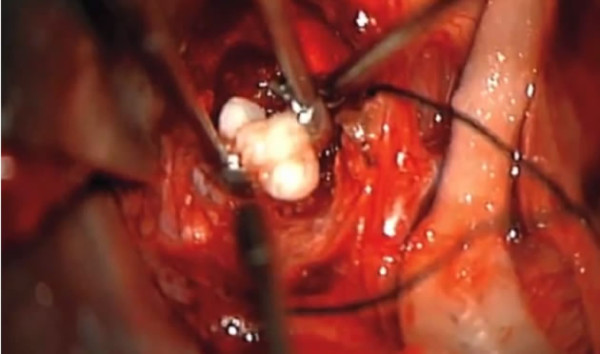 Video: Hallan dientes en el cerebro de un bebé