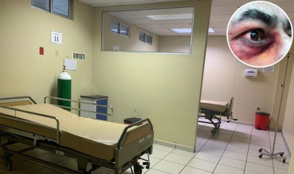 Primer paciente de hongo negro postcovid en Honduras recibe alta médica