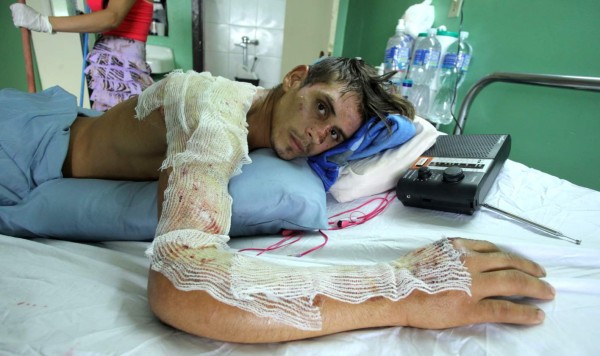 Lenta evolución de valiente joven quemado