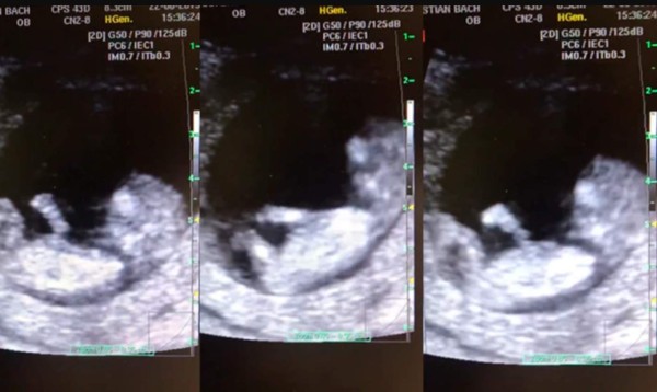 Video viral: Doctor descubre algo en ultrasonido de bebé que lo dejó maravillado