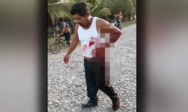 Hombre baleado camina pidiendo ayuda por las calles de Tocoa