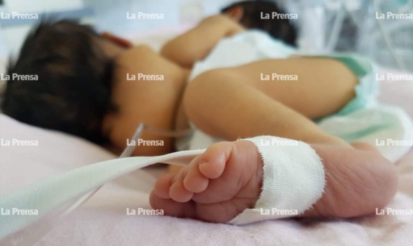 Fallece bebé que nació con malformación en el abdomen en Tegucigalpa
