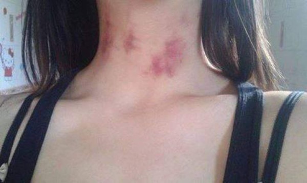 Llegó con moretones en su cuello y su novio le creyó la insólita excusa