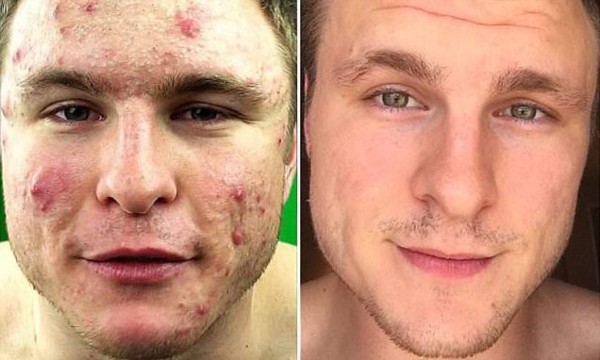 Sufría acné y con un cambio en la alimentación encontró la cura