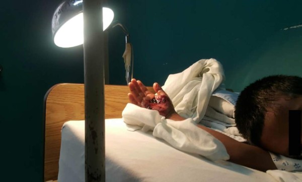 El niño de 7 años que fue quemado por su padrastro se recupera favorablemente