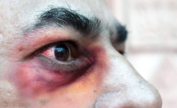 Investigan primer caso sospechoso de hongo negro en Honduras