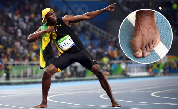 Así de feos son los pies de Usain Bolt