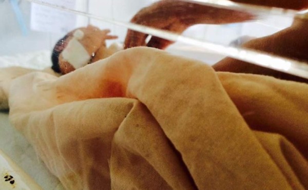Muere el segundo bebé con microcefalia en Honduras en el 2017