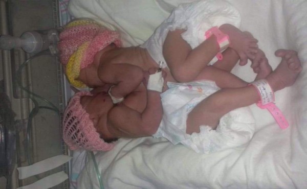 Padres de siamesas piden visa humanitaria