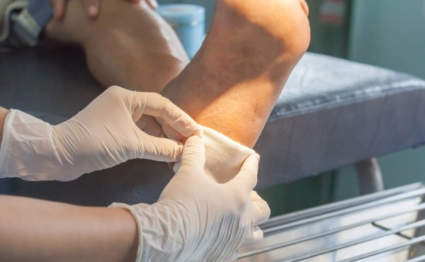 Amputaciones por pie diabético se duplican