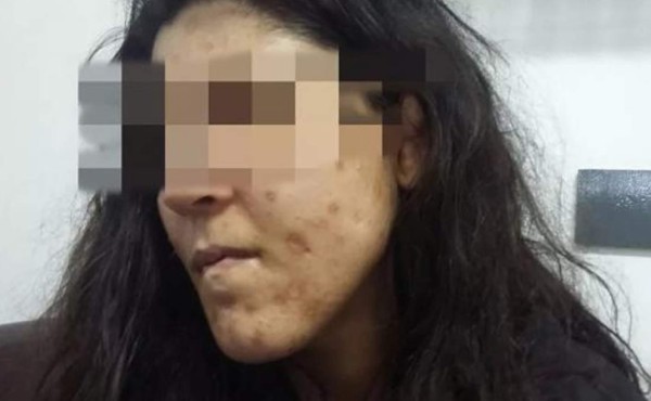 Padre apagó cigarros en la piel de su hija durante dos años