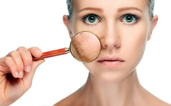 Si no quieres tener acné, evita estos alimentos