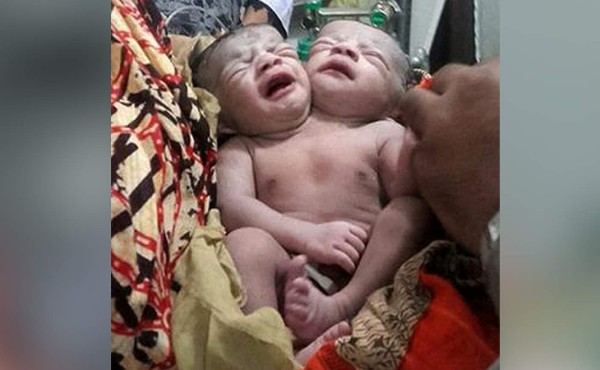Nace un niña con dos cabezas en Bangladesh