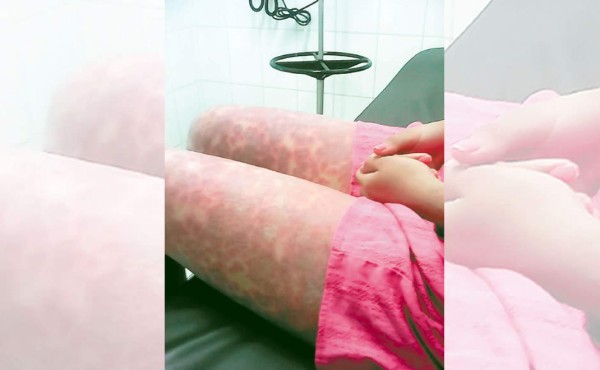 Médicos del IHSS advierten por inyecciones a pacientes con zika